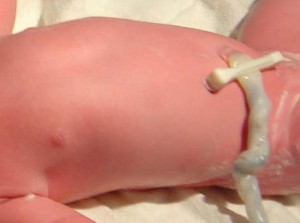 Le cordon ombilical du bébé est clamper avec une pince